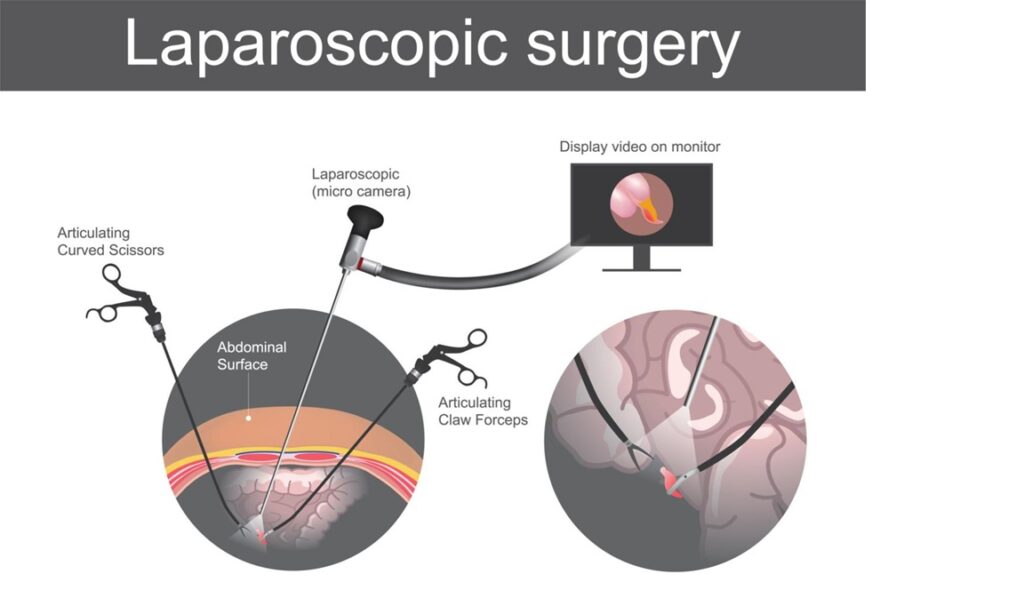 Laparoscopic hernia repair diagram Hyderabad surgeon
