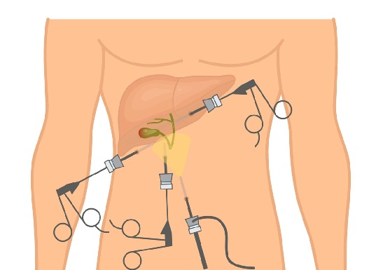 Gallbladder stone laparoscopic surgery Hyderabad cholecystectomy