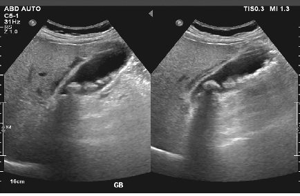 Gallbladder stone laparoscopic surgery Hyderabad cholecystectomy