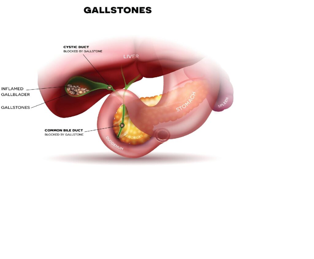 Laparoscopic gallbladder surgery in progress — minimally invasive procedure