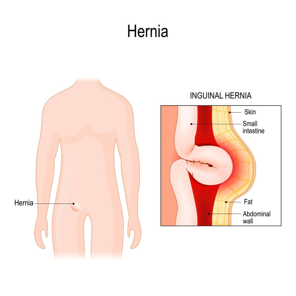 Hernia surgery in Hyderabad by Dr Sujeeth Kumar Bashetty