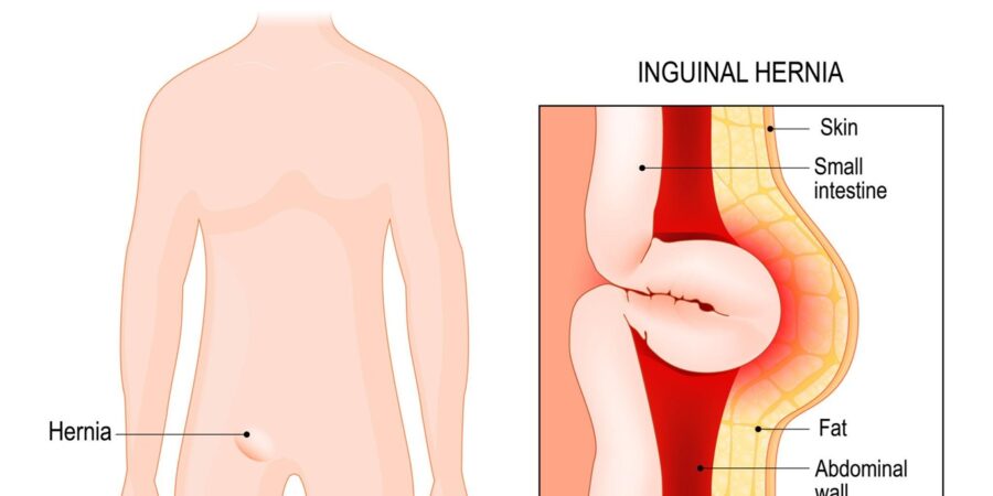 Hernia surgery in Hyderabad by Dr Sujeeth Kumar Bashetty