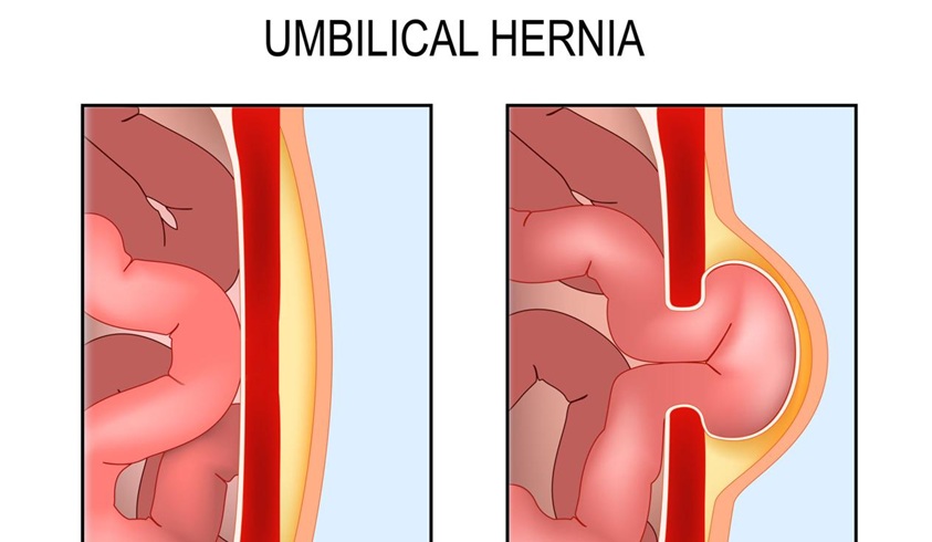 Laparoscopic hernia repair diagram Hyderabad surgeon