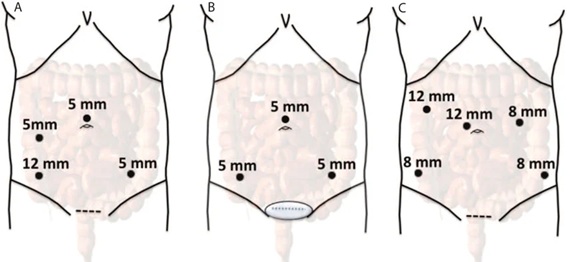 Laparoscopy surgery visuals